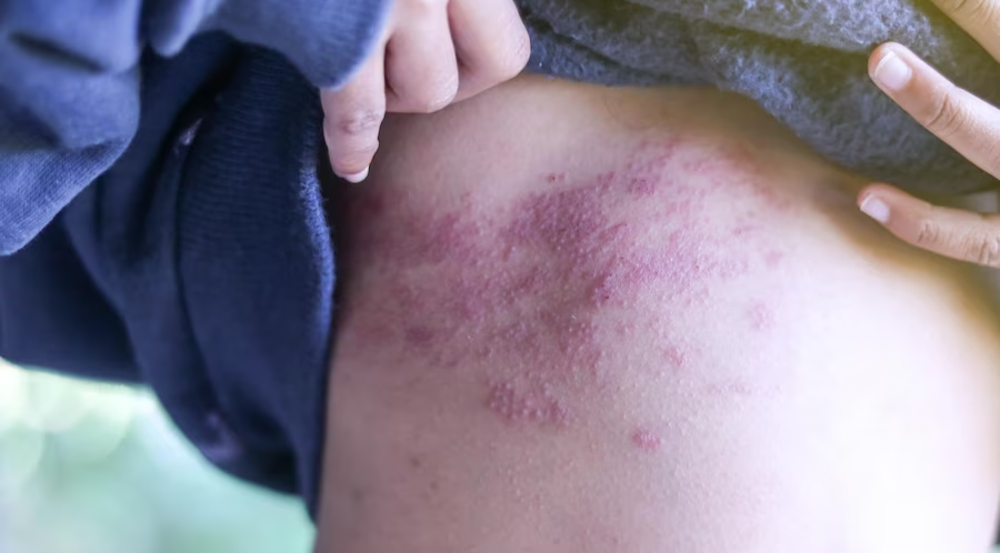 person suffering from eczema