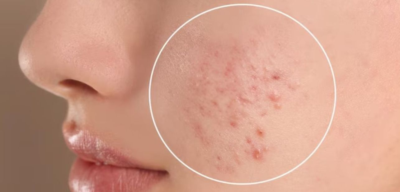 skin acne