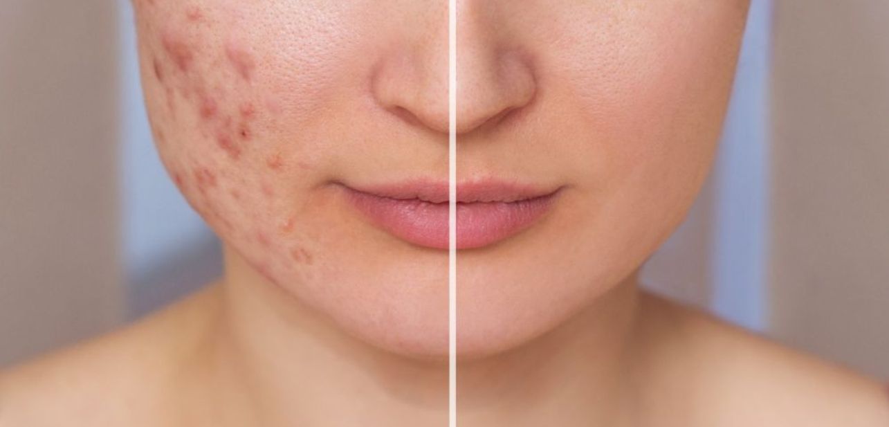 skin-acne 